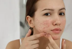 acne cream